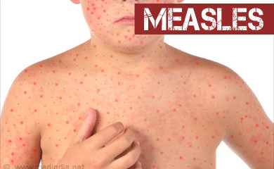 Measles_ sign, symptoms, lifestyle changes, Diet, and home remedies
