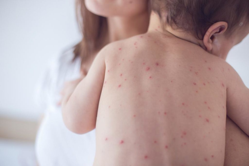 Measles_ sign, symptoms, lifestyle changes, Diet, and home remedies 