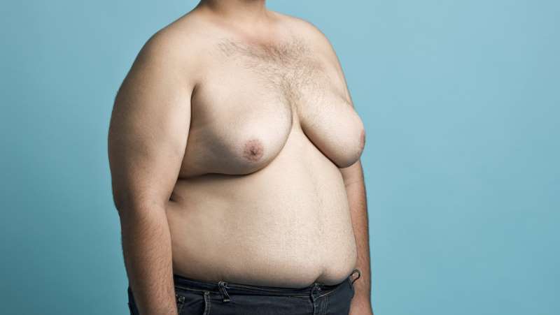 Gynecomastia